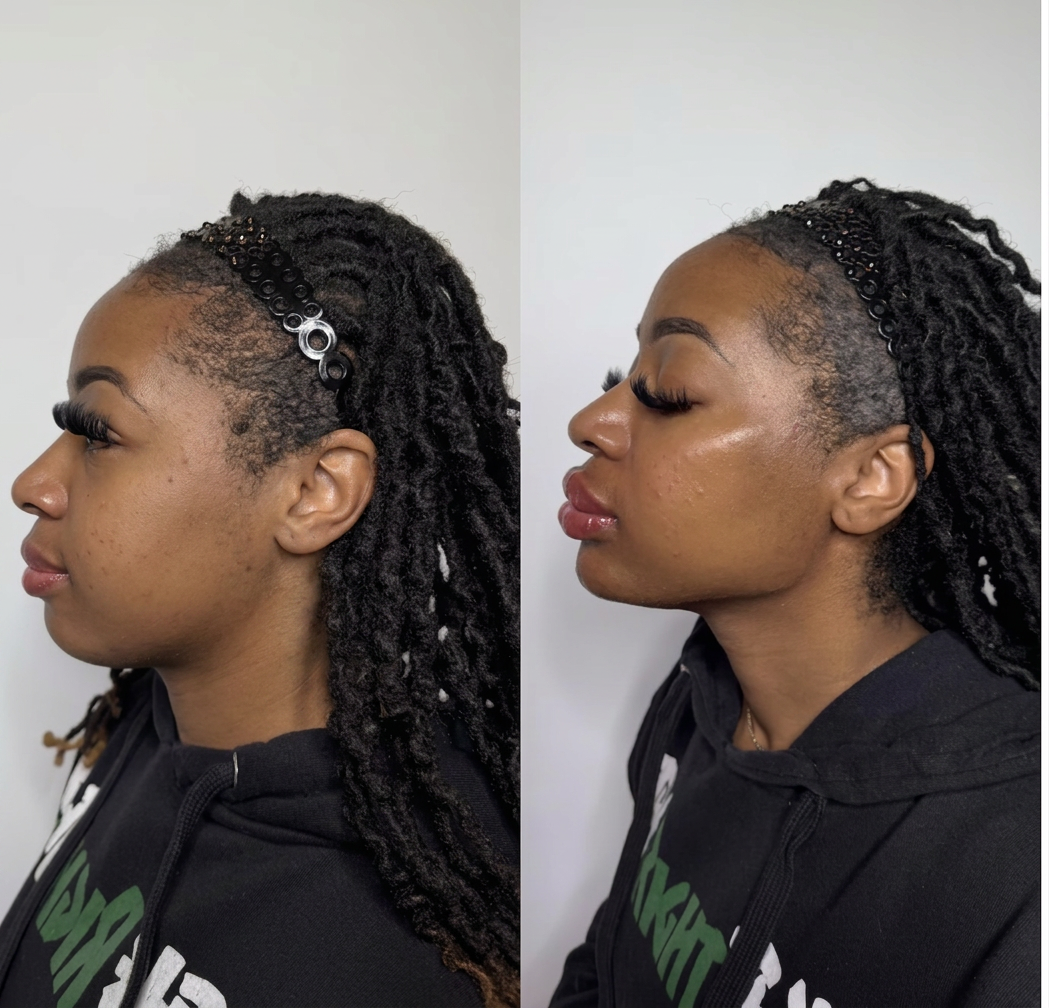 Real result — Jawline Contouring